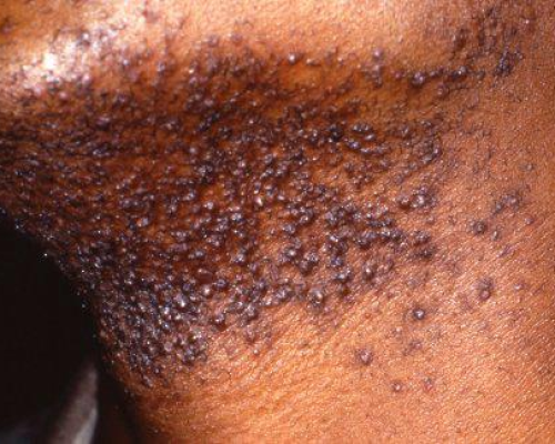 razor-bump-removal